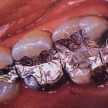 Amalgamas-42262_218x218