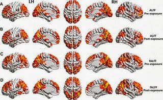 Imágenes del cerebro antes y después de la exposición